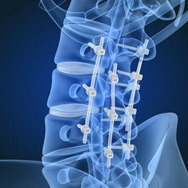 Spinal Fusion Surgery