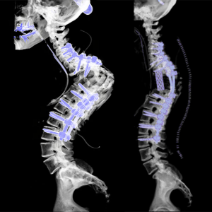 Spinal Reconstruction Surgery In Mumbai Dr Saijyot Raut